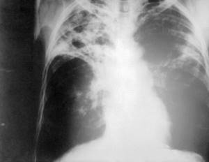 Туберкулез легких: симптомы, формы, диагностика