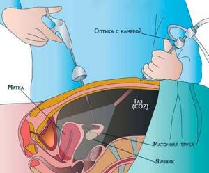 Беременность после лапароскопии: через какое время наступает, реабилитация после лапароскопии маточных труб, внематочной беремености