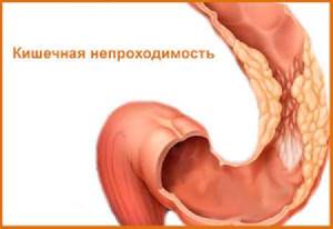 Дивертикулез кишечника: симптомы, лечение