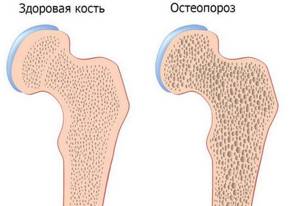 Остеопороз: симптомы, причины, статистика