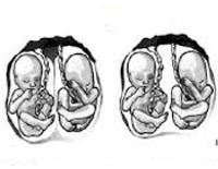 Беременность двойней: признаки, диагностика, осложнения
