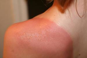 Подсчитан процент, насколько солнцезащитные средства снижают риск меланомы