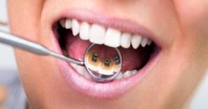 Брекет-системы: виды, сколько носить, чтобы выровнять зубы, сколько стоит установка