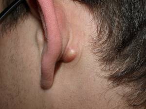 Лечение атеромы: удаление атеромы за ухом, на голове