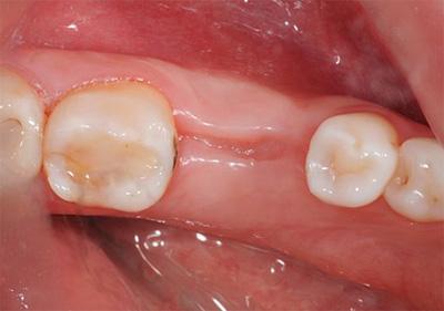 Болит зуб: виды боли, причины боли после лечения, удаления, болит десна