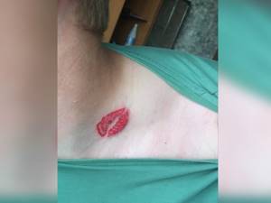 Провокатором рака кожи может служить удаление татуировок