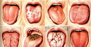 Онемение языка и губ: причины, что делать