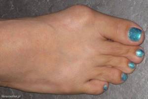 Причины появления косточек на больших пальцах ног, возможно ли эффективное лечение