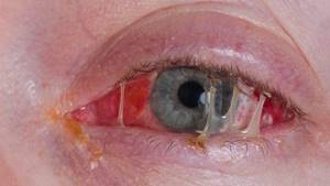 Аллергия вокруг глаз - симптомы, лечение, фото