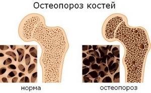 Лечение остеопороза народными средствами, лекартсвенными растениями, правильное питание