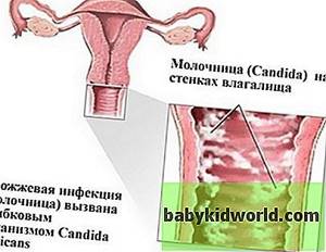 Молочница у женщин симптомы, фото, признаки