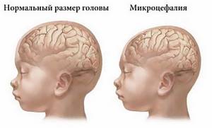 Микроцефалия у детей: симптомы, причины, диагностика у плода и новорожденных
