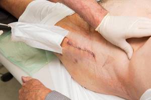Эндопротезирование тазобедренного сустава: операция и реабилитация после лечения