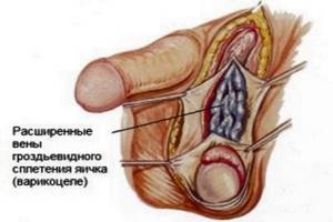 Причина и лечение боли в правом или левом яичке у мужчин