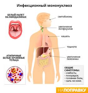 Инфекционный мононуклеоз у детей - симптомы, лечение, последствия