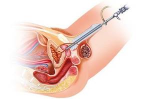 Цистоскопия мочевого пузыря: как делают у женщин, мужчин, показания, подготовка, результаты