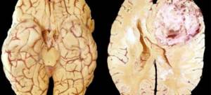 Опухоль головного мозга: симптомы, причины, лечение, виды, диагностика, прогноз
