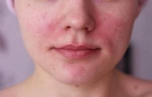 Причины нездорового цвета кожи лица: желтый, землистый, оливковый, серый, бледный, красный
