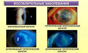 Неврит зрительного нерва: симптомы, лечение, причины, что делать, прогноз