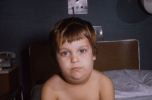 Паротит: симптомы у детей и взрослых, причины, лечение, диагностика, прививка