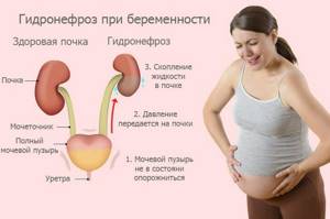 Гидронефроз почек у детей, взрослых, при беременности. Диагностика и лечение заболевания