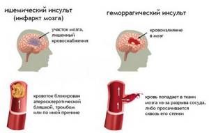 Нарушение кровообращения мозга: симптомы, препараты