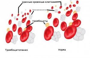 Низкие тромбоциты в крови - причины тромбоцитопении