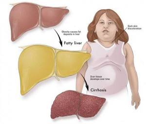 Жировой гепатоз печени: симптомы, причины