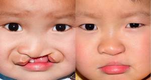 Заячья губа у детей: причины возникновения, операция, вид до и после лечения