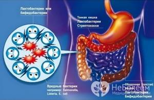Дисбактериоз кишечника: симптомы у детей и взрослых, причины дисбактериоза