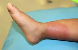 Симптомы и лечение рожистого воспаления: ноги, руки, кожи лица
