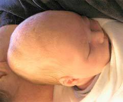 Кефалогематома - гематома у новорожденных на голове: последствия, лечение