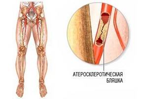 Атеросклероз сосудов ног: лечение, симптомы