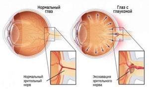 Глаукома: симптомы, лечение, причины, препараты, операция, прогноз