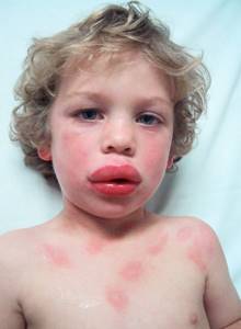 Аллергия на цитрусовые - симптомы