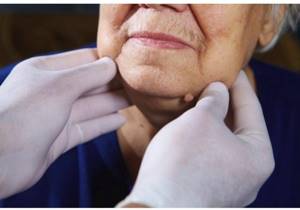 Воспаление лимфоузлов на шее: симптомы и лечение шейного лимфаденита, причины почему болят лимфоузлы на шее