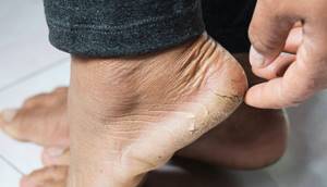 Лечение трещин на пятках, крема, мази, ванночки, народные средства для увлажнения,заживления растрескавшейся кожи ног