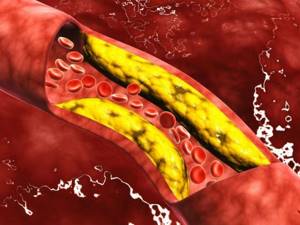 Как снизить холестерин без лекарств: продукты снижающие холестерин в крови
