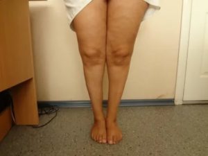 Атрофия мышц: ног, рук, лечение, симптомы, причины, как восстановить атрофировнные ткани