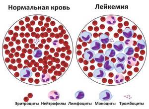 Признаки рака крови