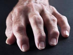 Ревматоидный артрит: симптомы, диагностика, лечение заболевания суставов