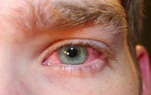 Красные глаза: причины, что делать, лечение у детей и взрослых