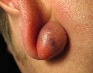 Лечение атеромы: удаление атеромы за ухом, на голове