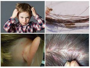 Лечение педикулеза у детей, откуда берутся вши и как их вывести?