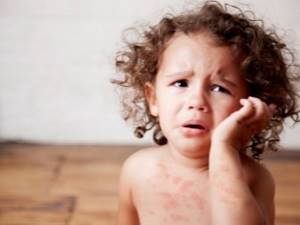 Крем, мазь от аллергии для детей - какой выбрать?