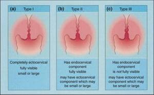 Лейкоплакия шейки матки: симптомы и лечение, диагностика, прогноз