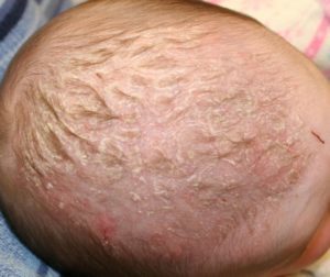 Себорея: кожи головы, на лице, лечение жирной и сухой себореи