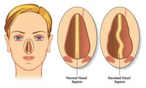Искривление носовой перегородки: операция, лечение, причины, симптомы
