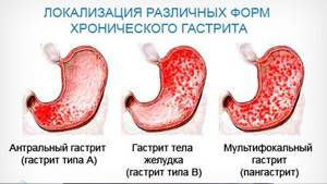 Гастрит желудка - симптомы, признаки, виды, диагностика