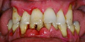 Кровоточат десны: что делать, причины постоянной кровоточивости десен при чистке зубов, лечение в домашних условиях